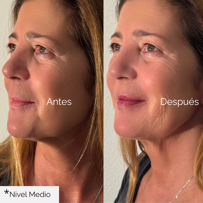 Voluminizador de Labios